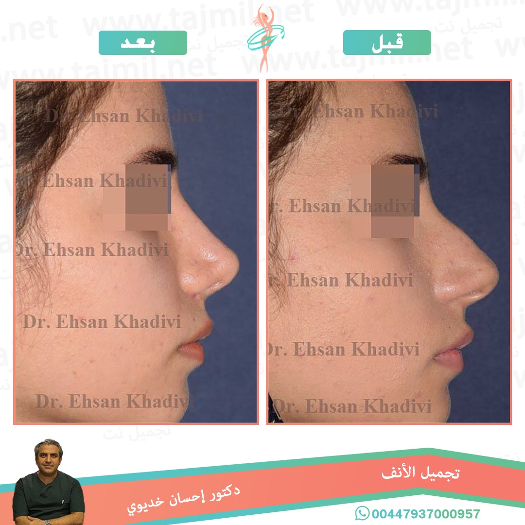  - دکتور إحسان خدیوي عملية تجميل الانف في ايران مع تجميل نت