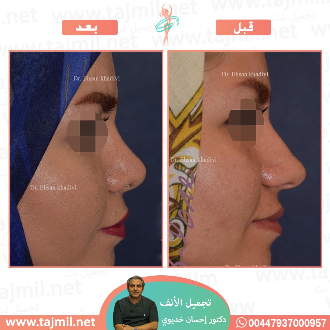  - دکتور إحسان خدیوي عملية تجميل الانف في ايران مع تجميل نت