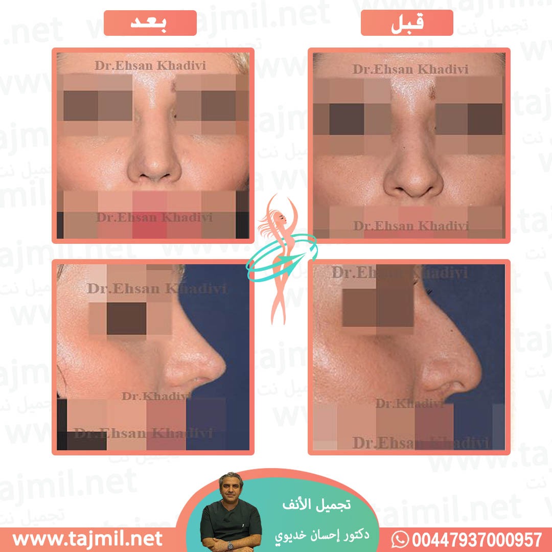  - دکتور إحسان خدیوي عملية تجميل الانف في ايران مع تجميل نت