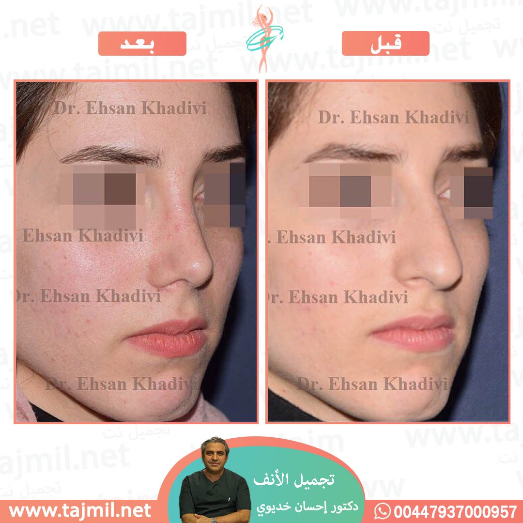  - دکتور إحسان خدیوي عملية تجميل الانف في ايران مع تجميل نت