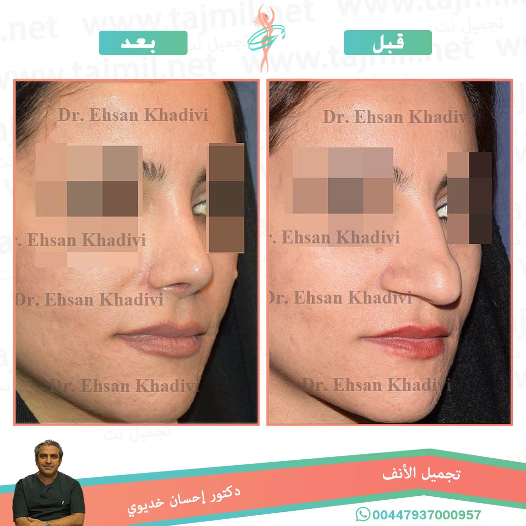  - دکتور إحسان خدیوي عملية تجميل الانف في ايران مع تجميل نت