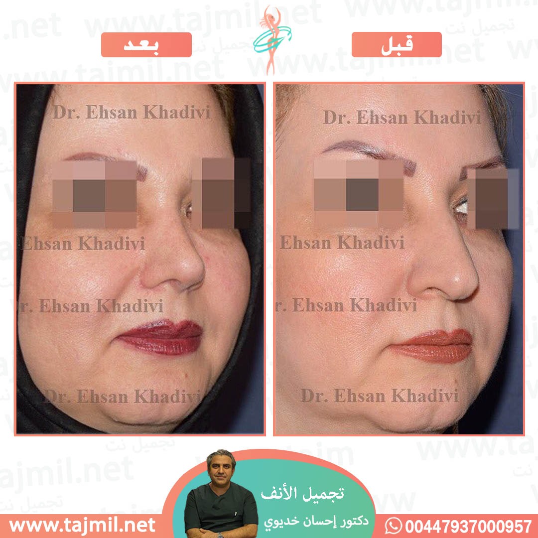  - دکتور إحسان خدیوي عملية تجميل الانف في ايران مع تجميل نت