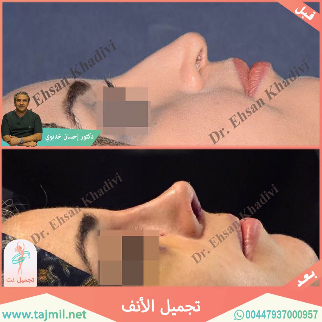  - دکتور إحسان خدیوي عملية تجميل الانف في ايران مع تجميل نت