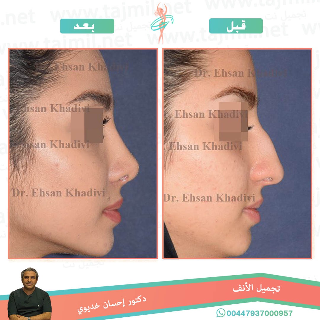  - دکتور إحسان خدیوي عملية تجميل الانف في ايران مع تجميل نت