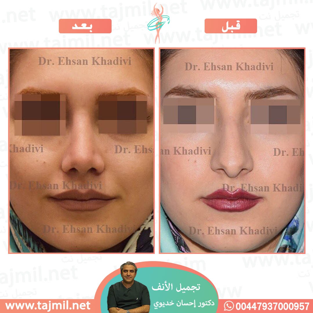  - دکتور إحسان خدیوي عملية تجميل الانف في ايران مع تجميل نت