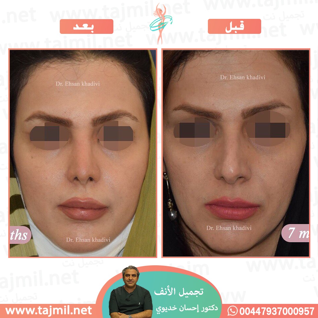  - دکتور إحسان خدیوي عملية تجميل الانف في ايران مع تجميل نت