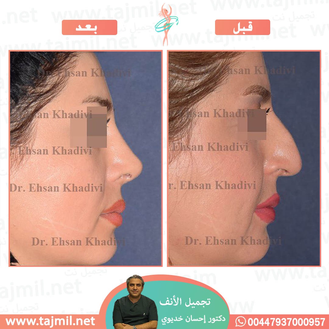  - دکتور إحسان خدیوي عملية تجميل الانف في ايران مع تجميل نت