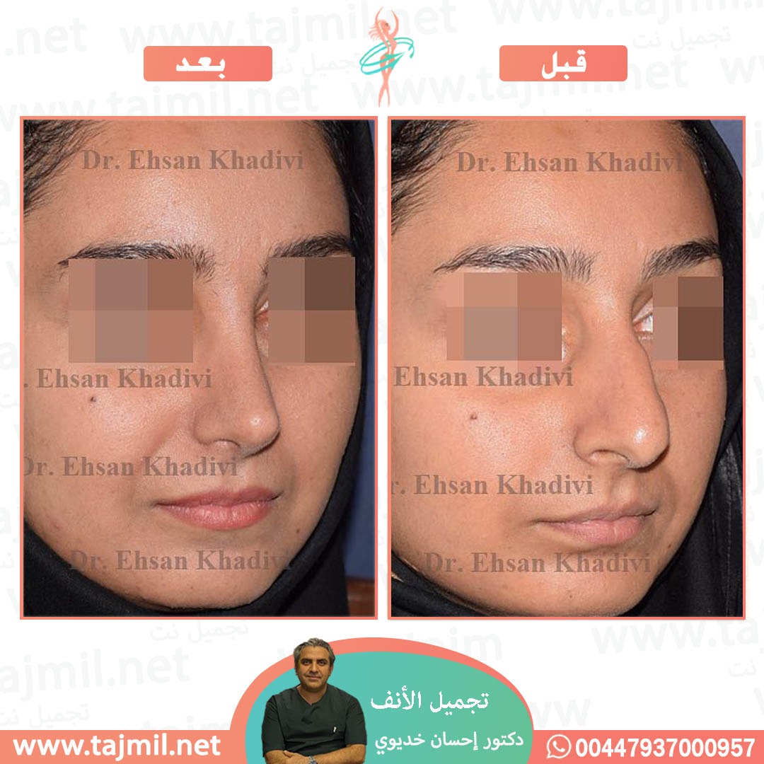  - دکتور إحسان خدیوي عملية تجميل الانف في ايران مع تجميل نت