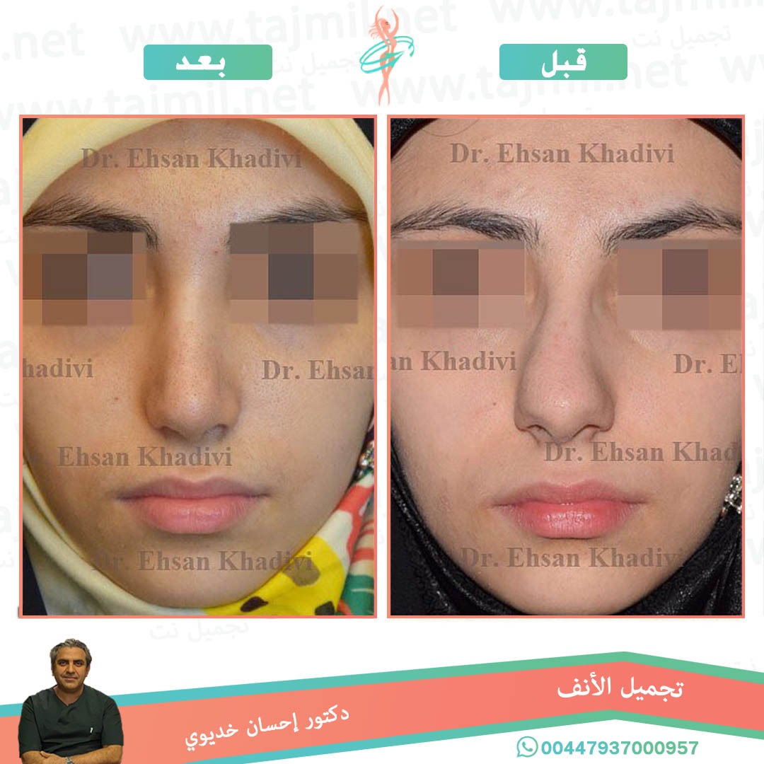  - دکتور إحسان خدیوي عملية تجميل الانف في ايران مع تجميل نت