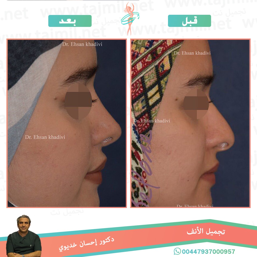  - دکتور إحسان خدیوي عملية تجميل الانف في ايران مع تجميل نت