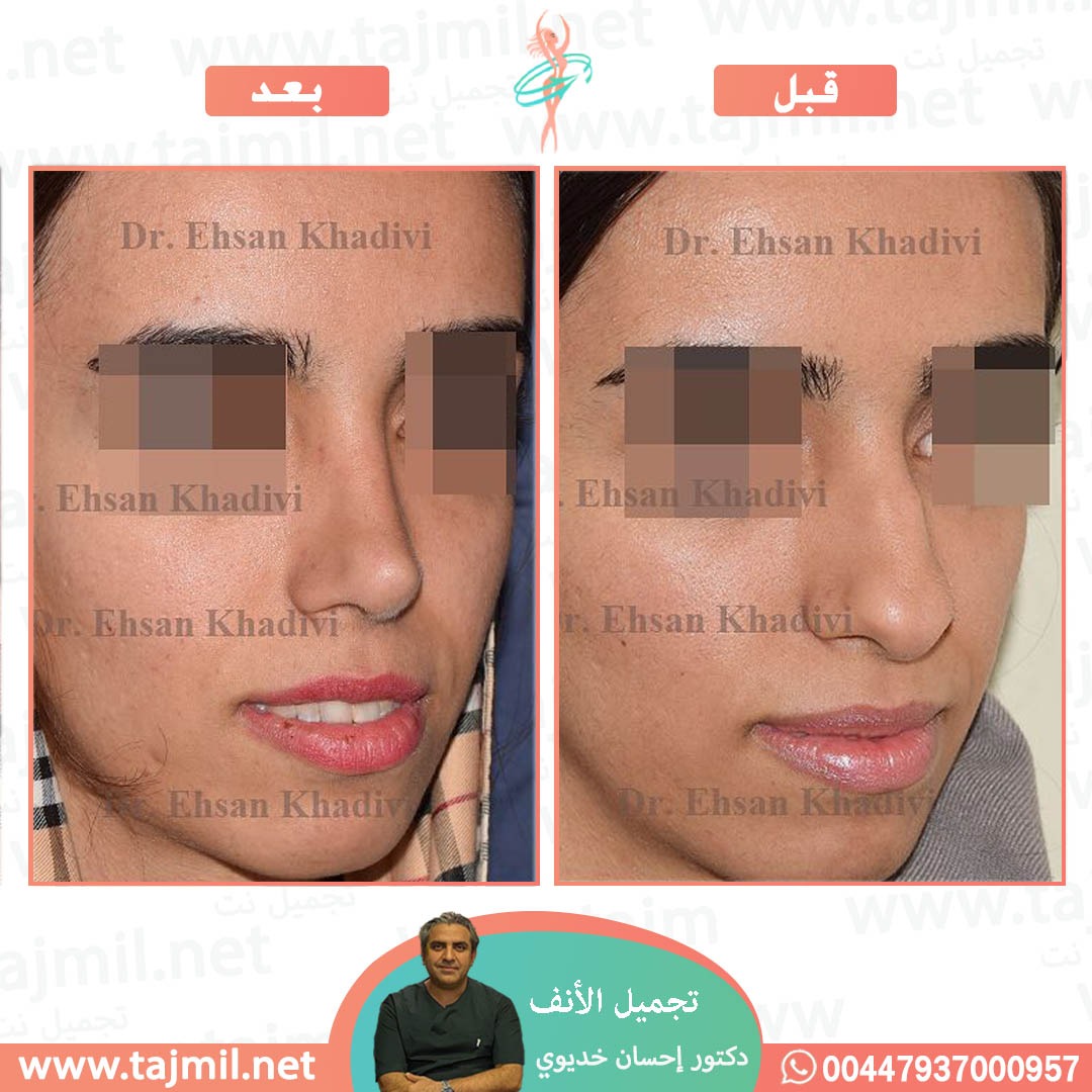  - دکتور إحسان خدیوي عملية تجميل الانف في ايران مع تجميل نت