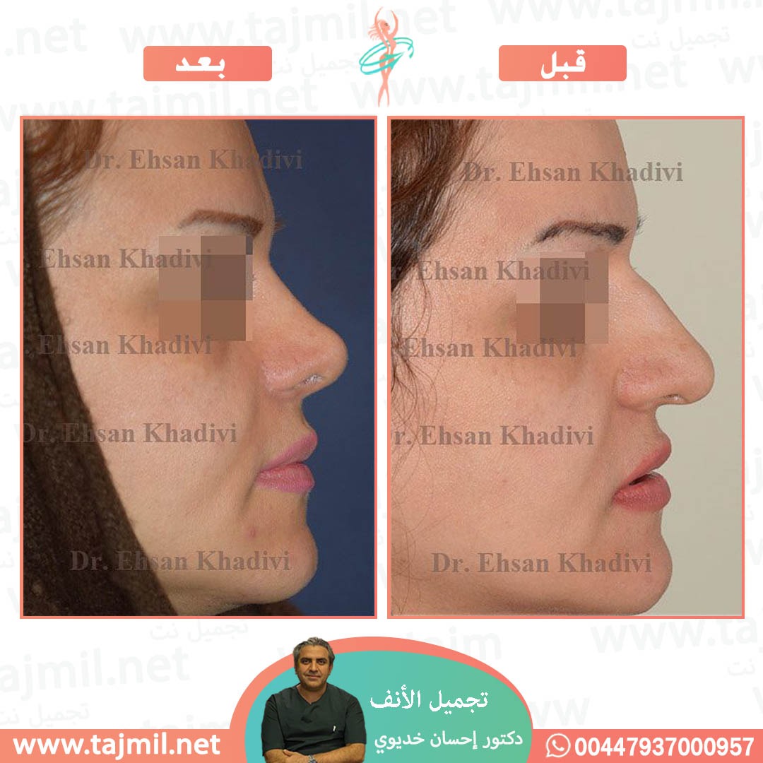  - دکتور إحسان خدیوي عملية تجميل الانف في ايران مع تجميل نت