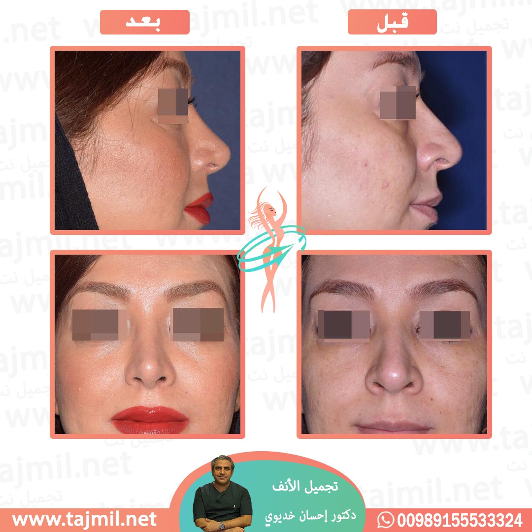  - دکتور إحسان خدیوي عملية تجميل الانف في ايران مع تجميل نت