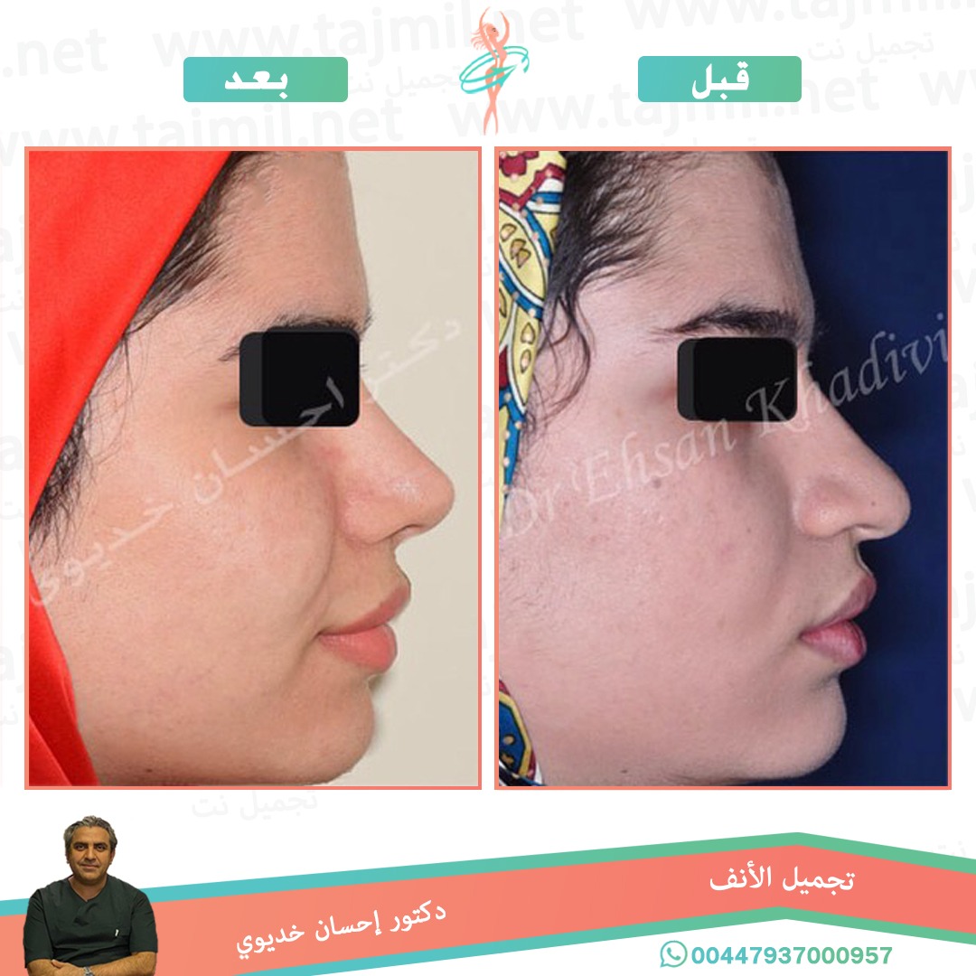  - دکتور إحسان خدیوي عملية تجميل الانف في ايران مع تجميل نت