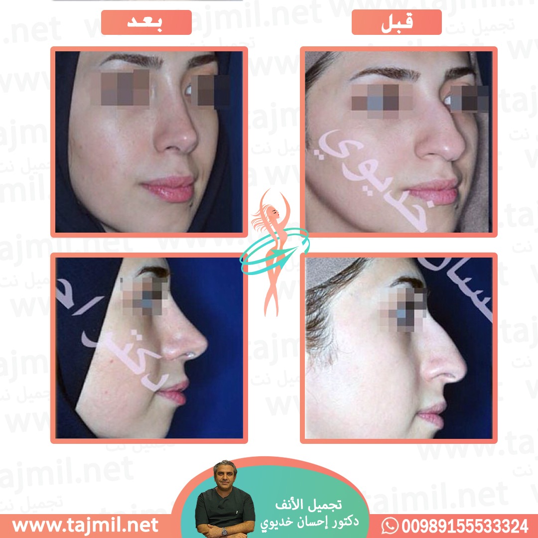  - دکتور إحسان خدیوي عملية تجميل الانف في ايران مع تجميل نت