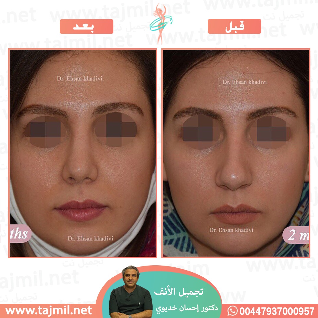  - دکتور إحسان خدیوي عملية تجميل الانف في ايران مع تجميل نت