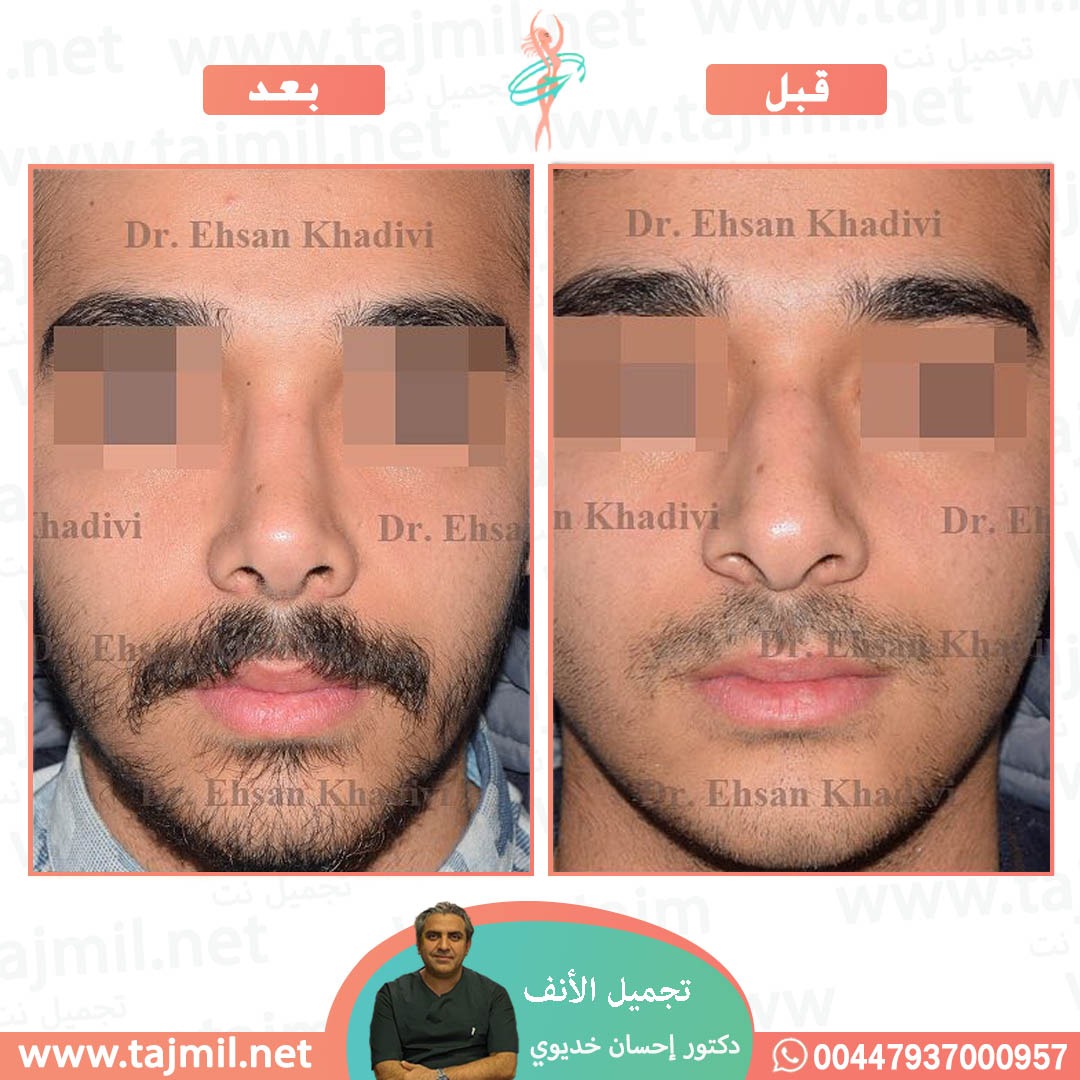  - دکتور إحسان خدیوي عملية تجميل الانف في ايران مع تجميل نت