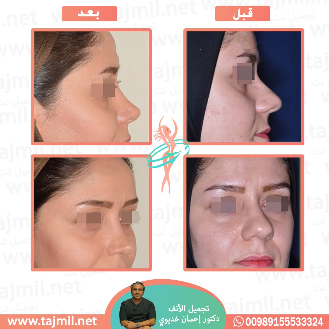  - دکتور إحسان خدیوي عملية تجميل الانف في ايران مع تجميل نت