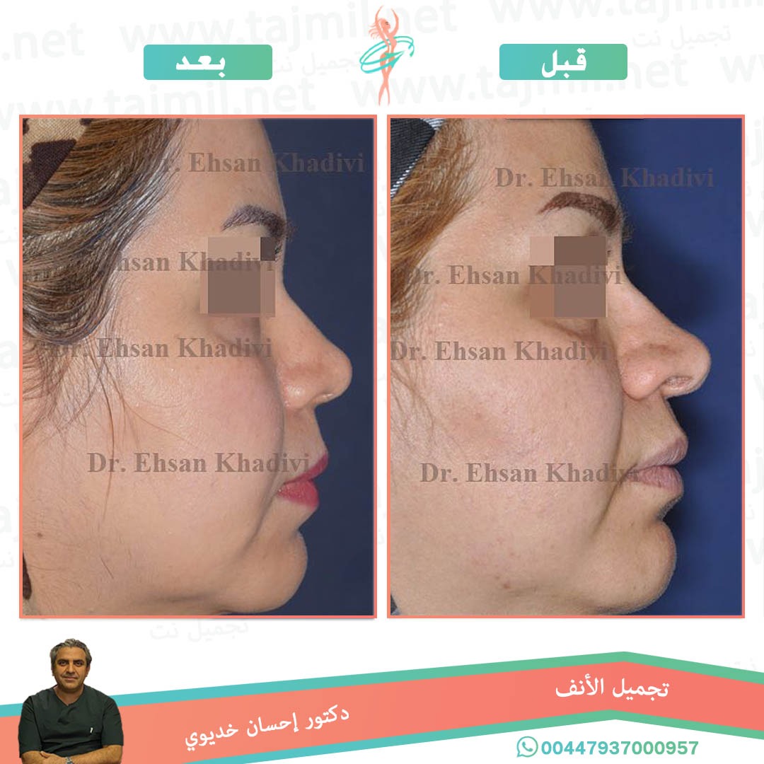  - دکتور إحسان خدیوي عملية تجميل الانف في ايران مع تجميل نت