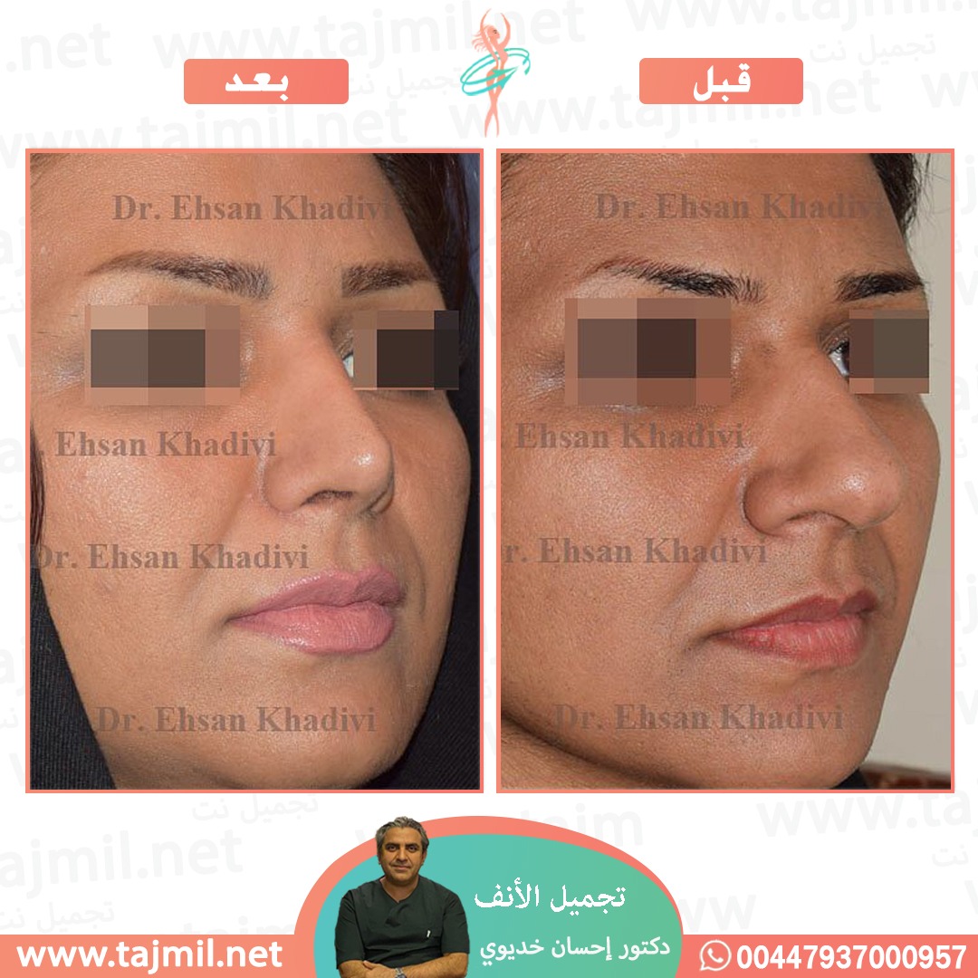  - دکتور إحسان خدیوي عملية تجميل الانف في ايران مع تجميل نت