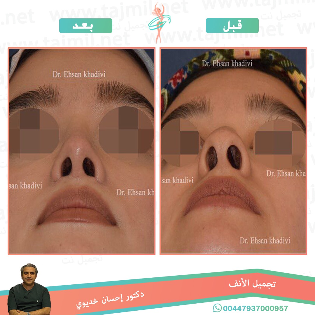  - دکتور إحسان خدیوي عملية تجميل الانف في ايران مع تجميل نت