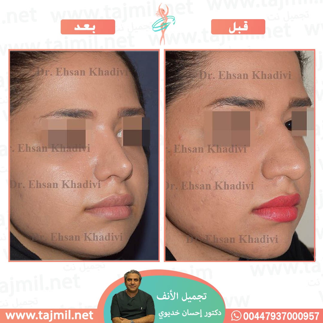  - دکتور إحسان خدیوي عملية تجميل الانف في ايران مع تجميل نت