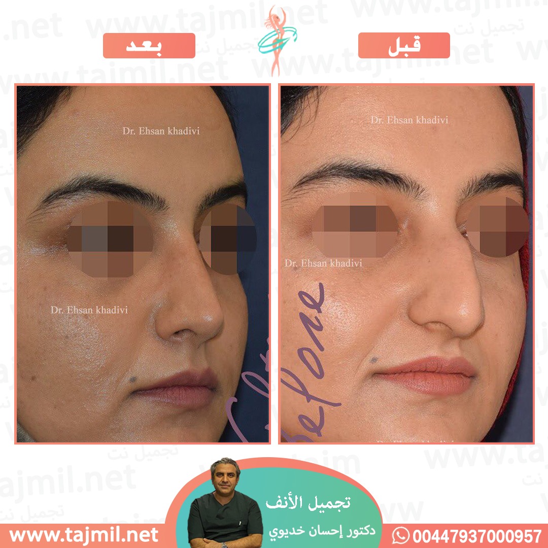  - دکتور إحسان خدیوي عملية تجميل الانف في ايران مع تجميل نت