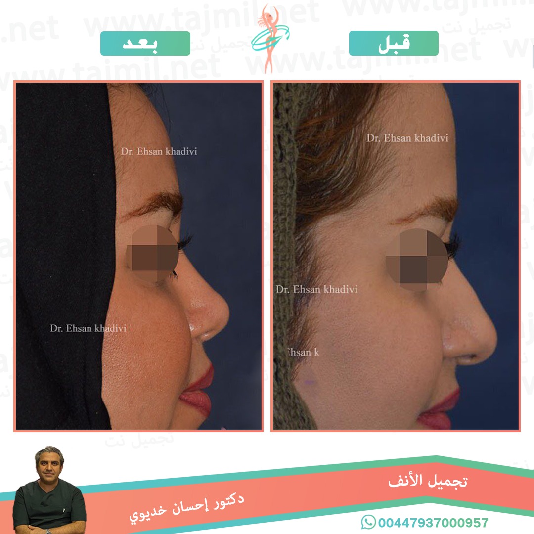  - دکتور إحسان خدیوي عملية تجميل الانف في ايران مع تجميل نت