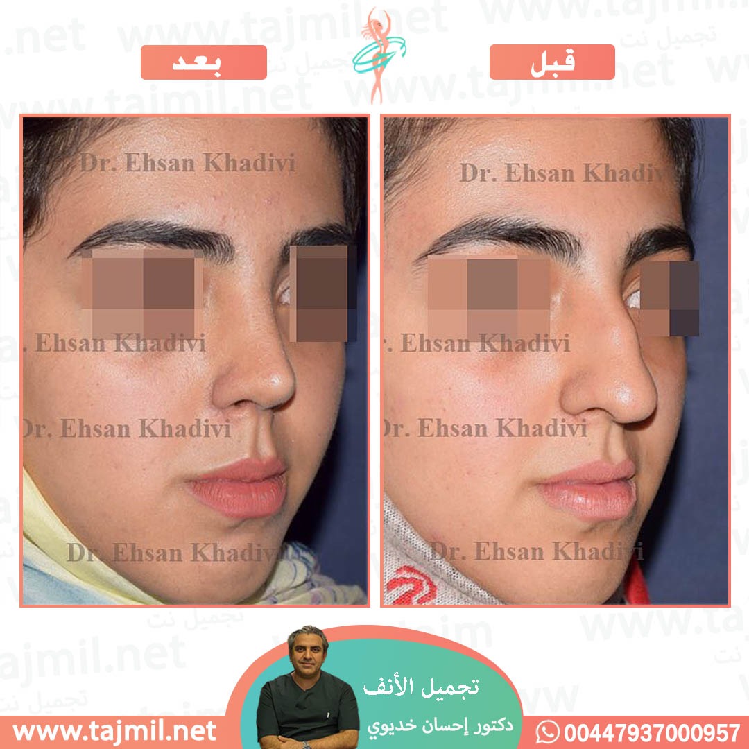  - دکتور إحسان خدیوي عملية تجميل الانف في ايران مع تجميل نت