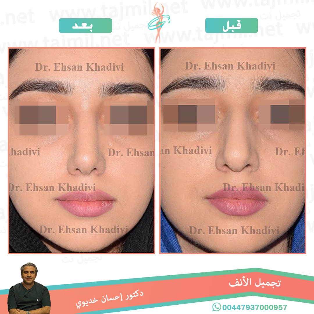  - دکتور إحسان خدیوي عملية تجميل الانف في ايران مع تجميل نت