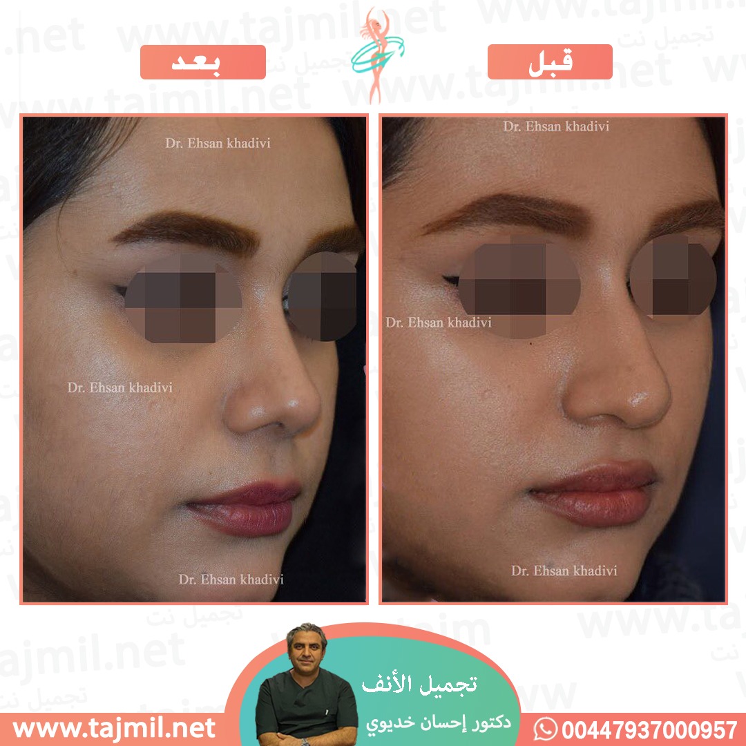  - دکتور إحسان خدیوي عملية تجميل الانف في ايران مع تجميل نت