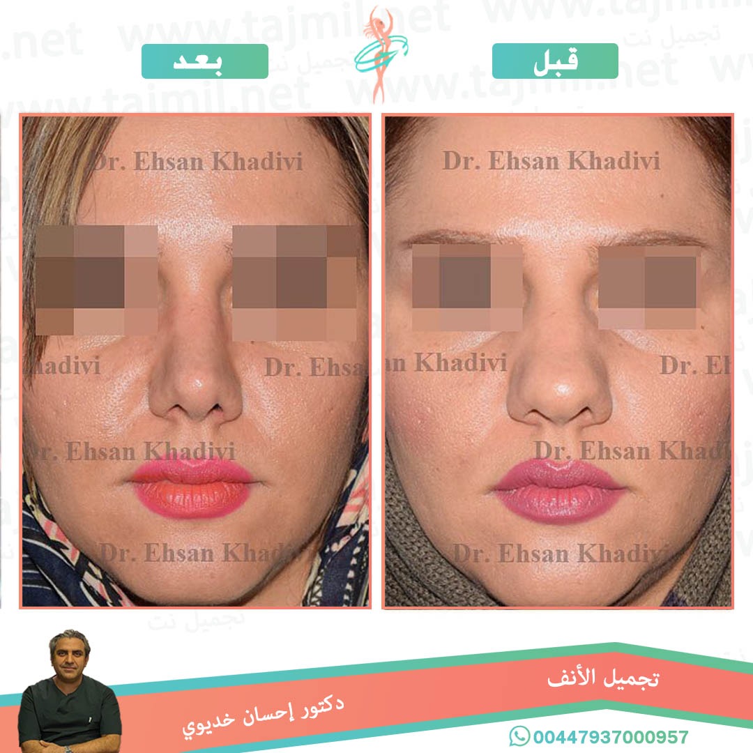  - دکتور إحسان خدیوي عملية تجميل الانف في ايران مع تجميل نت