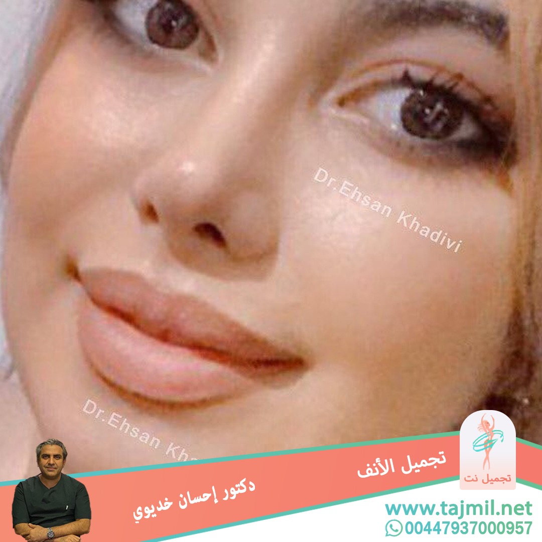  - دکتور إحسان خدیوي عملية تجميل الانف في ايران مع تجميل نت