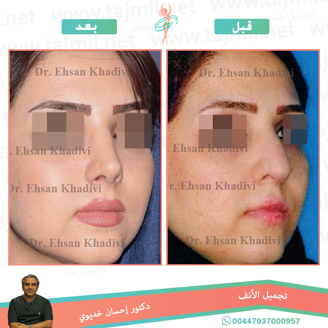  - دکتور إحسان خدیوي عملية تجميل الانف في ايران مع تجميل نت