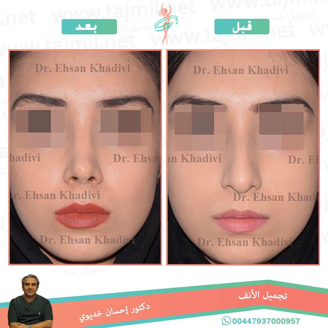  - دکتور إحسان خدیوي عملية تجميل الانف في ايران مع تجميل نت