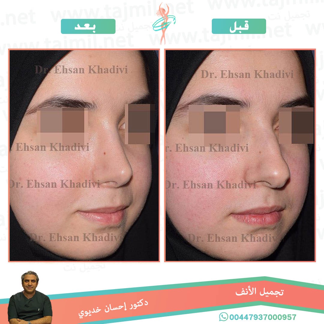  - دکتور إحسان خدیوي عملية تجميل الانف في ايران مع تجميل نت