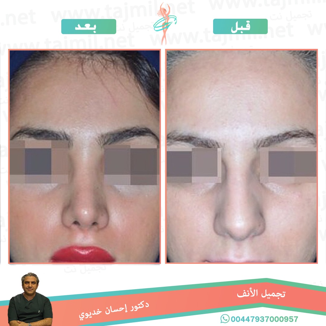  - دکتور إحسان خدیوي عملية تجميل الانف في ايران مع تجميل نت