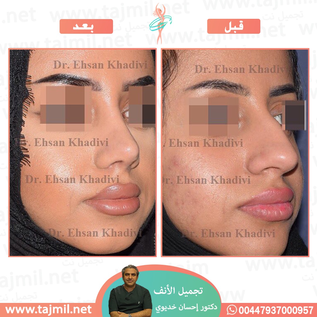  - دکتور إحسان خدیوي عملية تجميل الانف في ايران مع تجميل نت