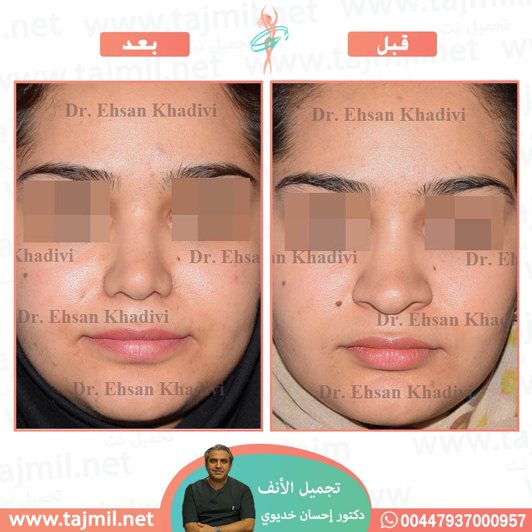  - دکتور إحسان خدیوي عملية تجميل الانف في ايران مع تجميل نت