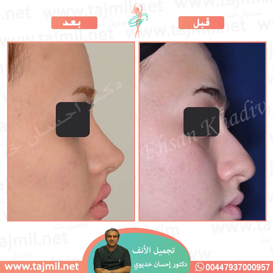  - دکتور إحسان خدیوي عملية تجميل الانف في ايران مع تجميل نت