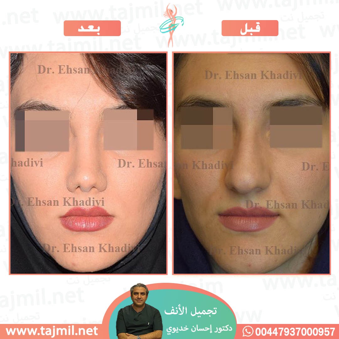  - دکتور إحسان خدیوي عملية تجميل الانف في ايران مع تجميل نت