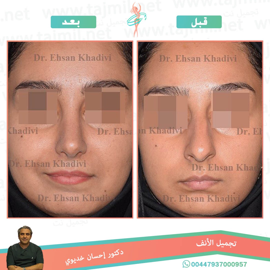  - دکتور إحسان خدیوي عملية تجميل الانف في ايران مع تجميل نت