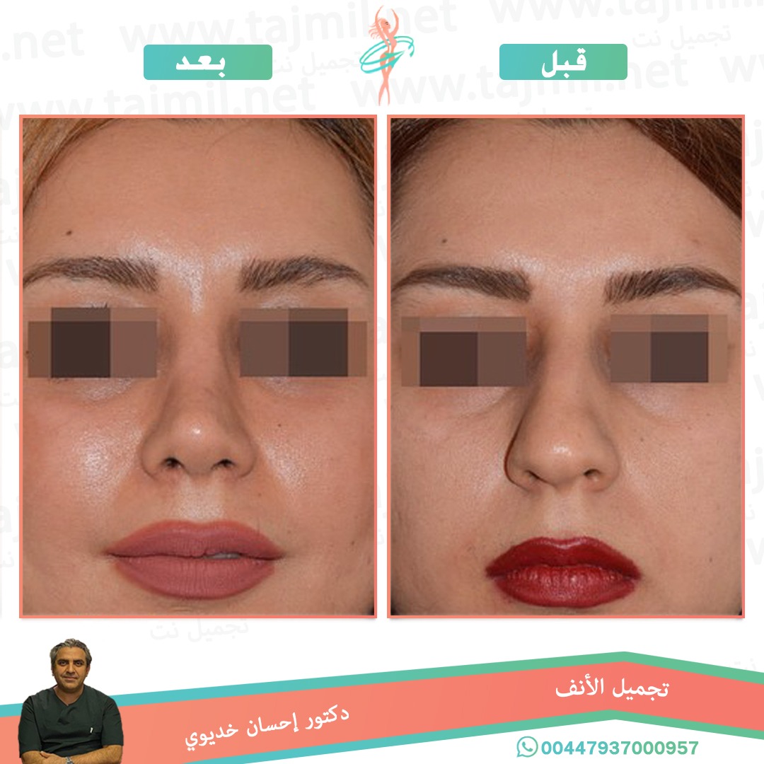  - دکتور إحسان خدیوي عملية تجميل الانف في ايران مع تجميل نت