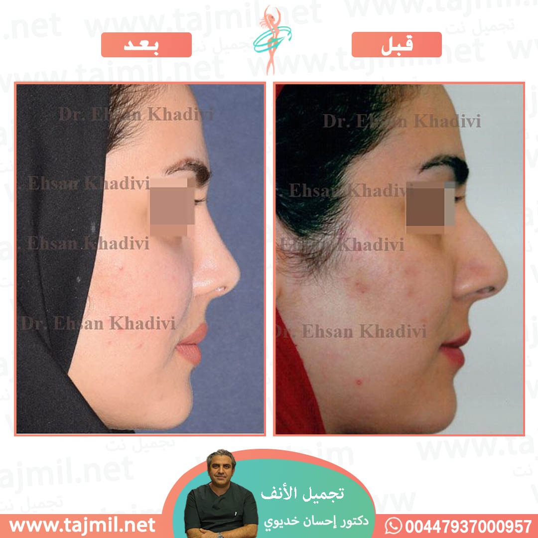  - دکتور إحسان خدیوي عملية تجميل الانف في ايران مع تجميل نت