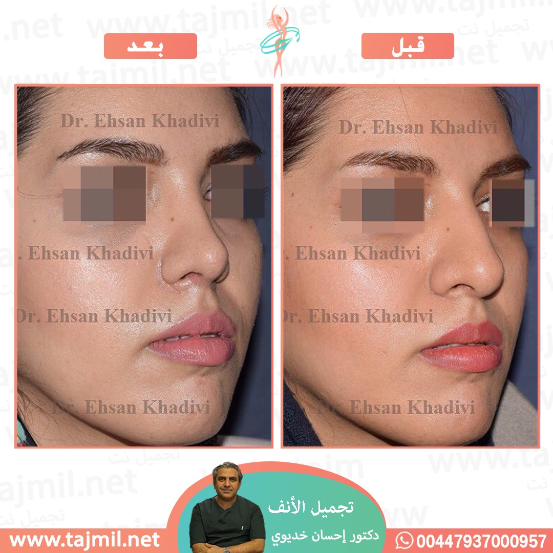  - دکتور إحسان خدیوي عملية تجميل الانف في ايران مع تجميل نت