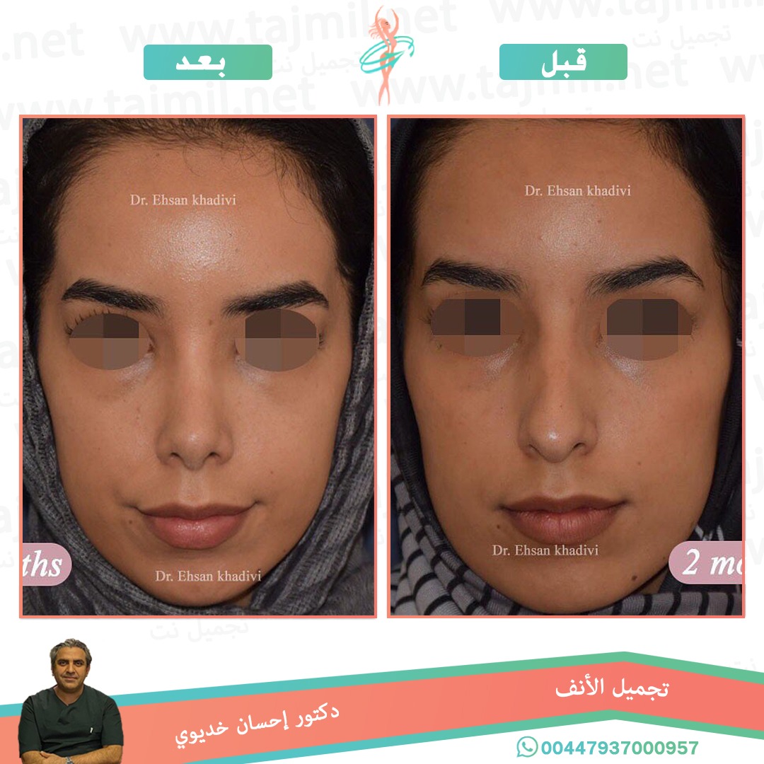  - دکتور إحسان خدیوي عملية تجميل الانف في ايران مع تجميل نت