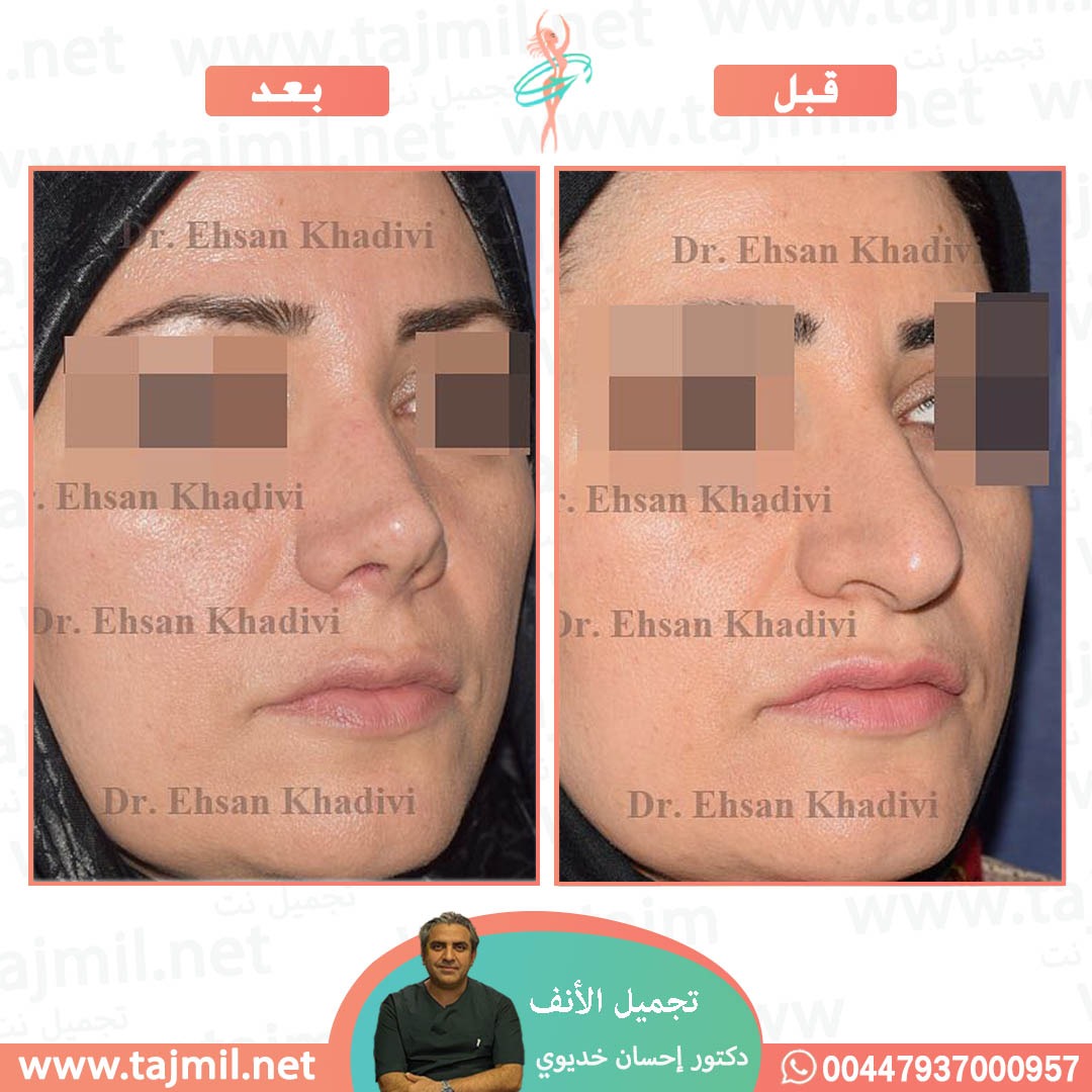  - دکتور إحسان خدیوي عملية تجميل الانف في ايران مع تجميل نت