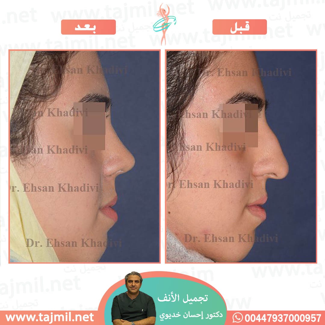  - دکتور إحسان خدیوي عملية تجميل الانف في ايران مع تجميل نت