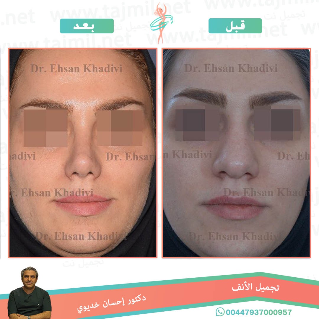  - دکتور إحسان خدیوي عملية تجميل الانف في ايران مع تجميل نت