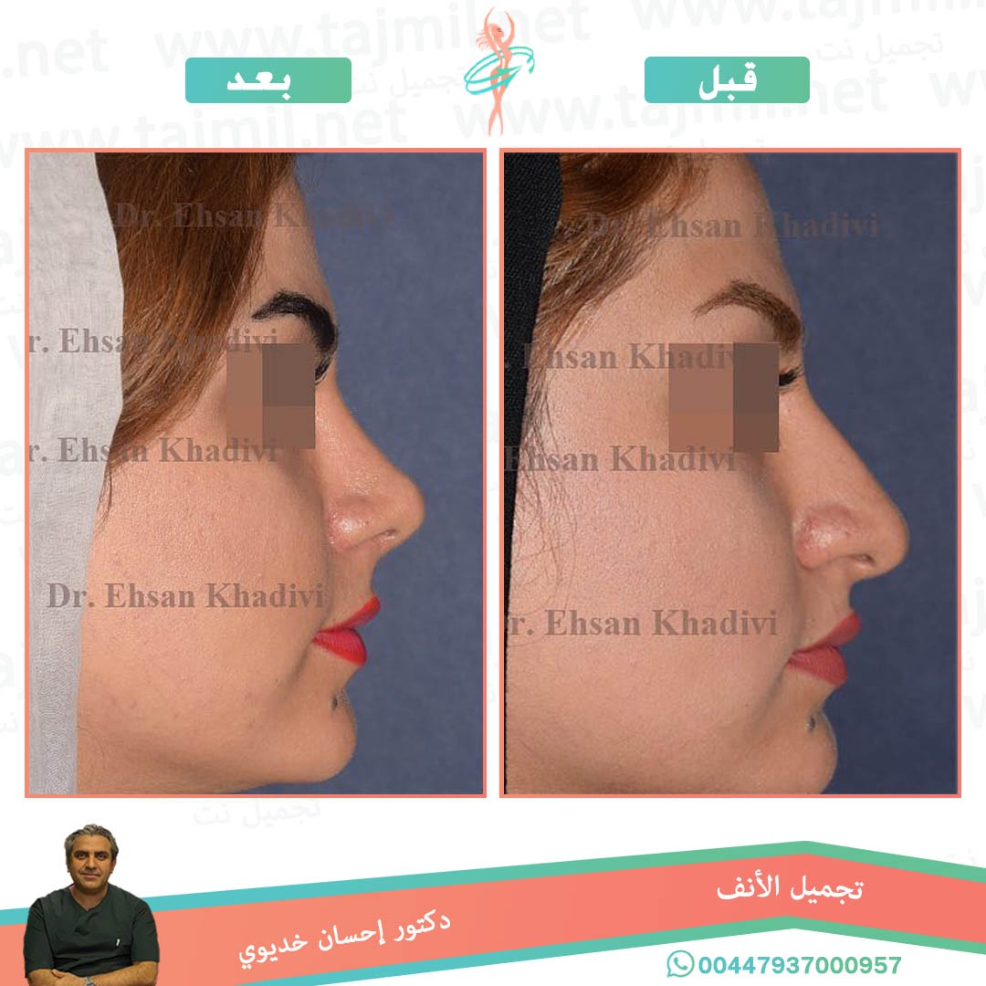  - دکتور إحسان خدیوي عملية تجميل الانف في ايران مع تجميل نت